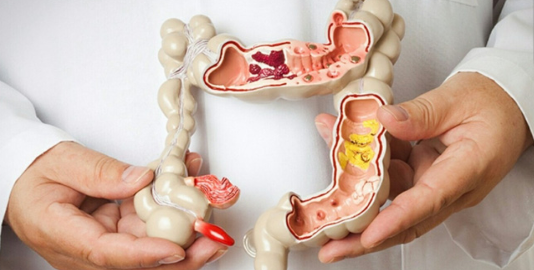 Nội soi đại tràng tiền mê dây Fuji 600