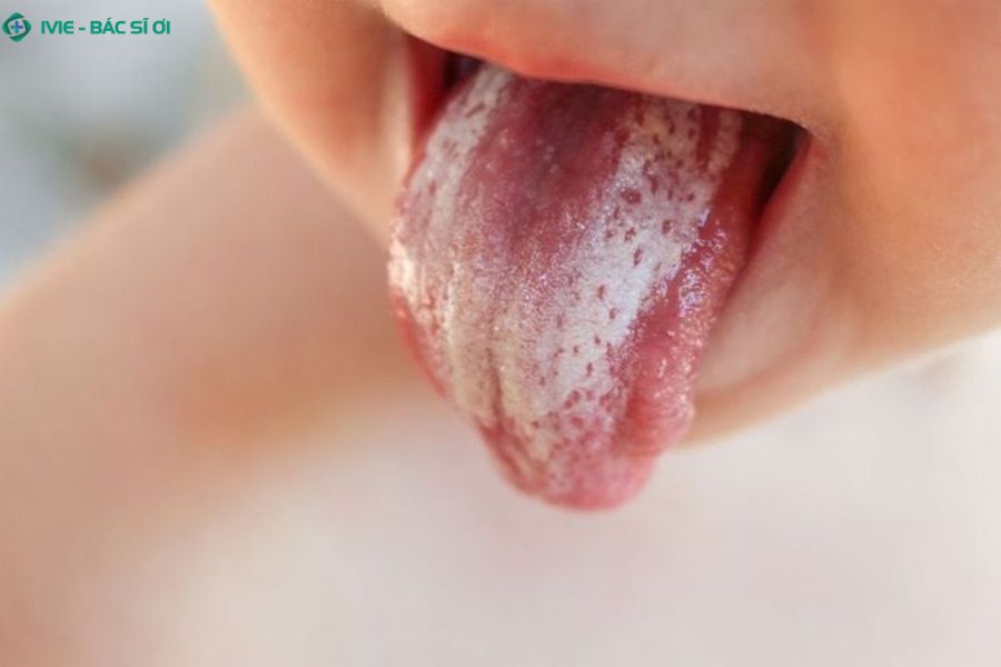 Những điều mẹ cần biết về nấm Candida