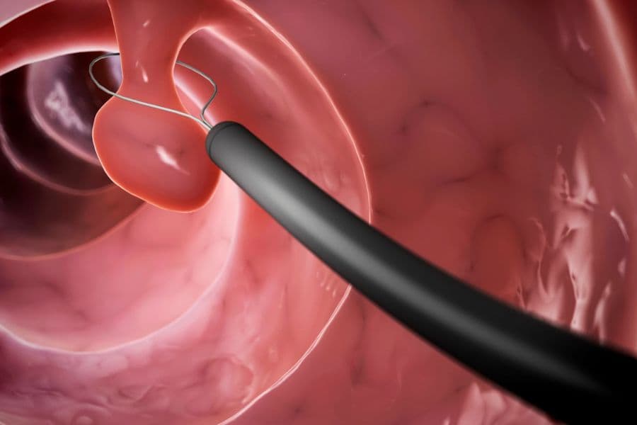 Polyp dạ dày có phải là ung thư không?