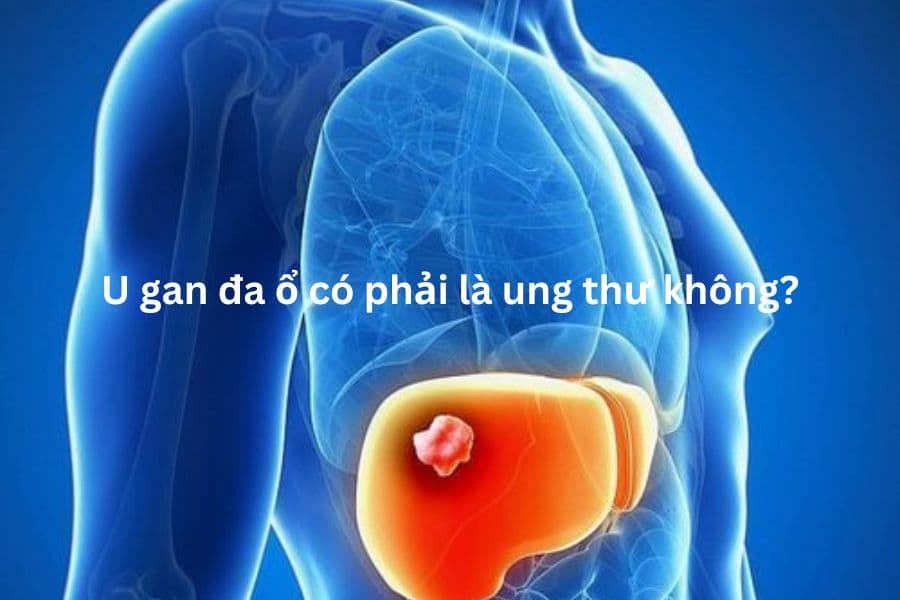 U gan đa ổ có phải là ung thư không?