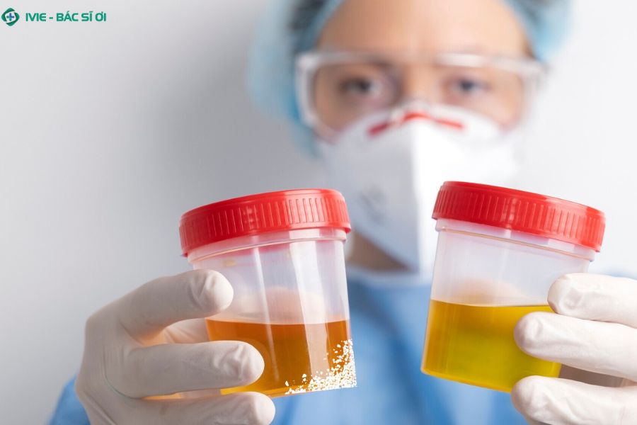 Nước tiểu để qua đêm có thể xuất hiện cặn trắng do cô đặc và lắng đọng khoáng chất