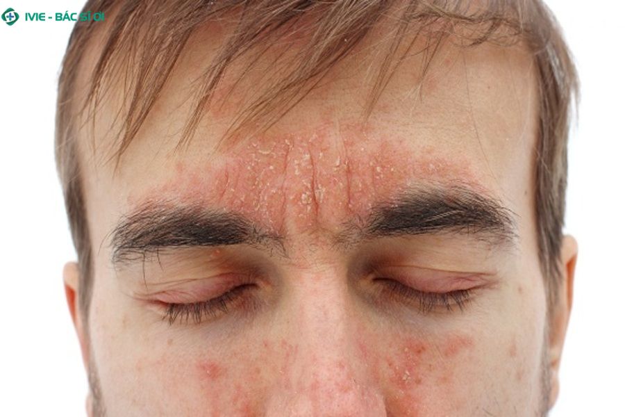 Dấu hiệu viêm da cơ địa mặt ở người lớn