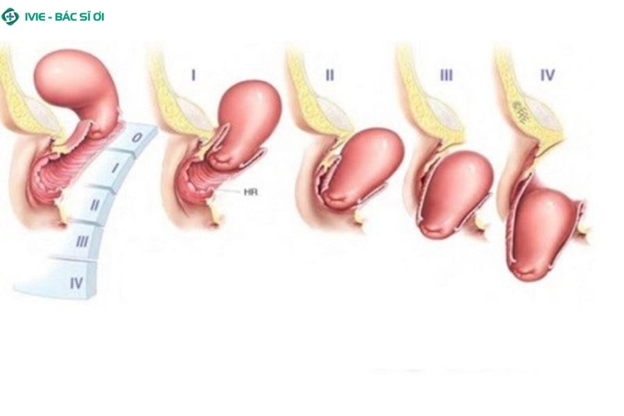 Nhận biết sớm cấp độ sa tử cung giúp điều trị hiệu quả và bảo tồn chức năng vùng chậu
