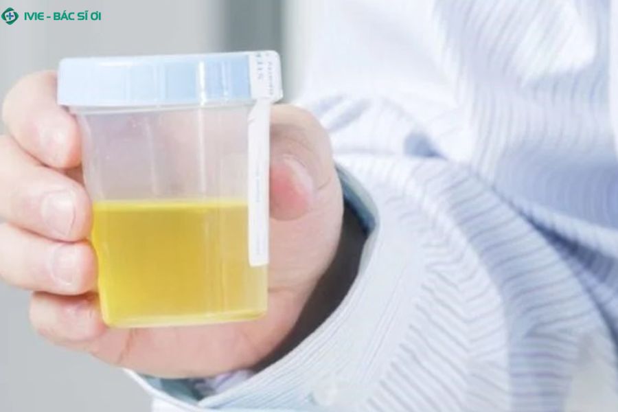 Đi tiểu màu vàng đậm có thể là dấu hiệu cảnh báo bất thường về gan, thận hoặc đường tiết niệu