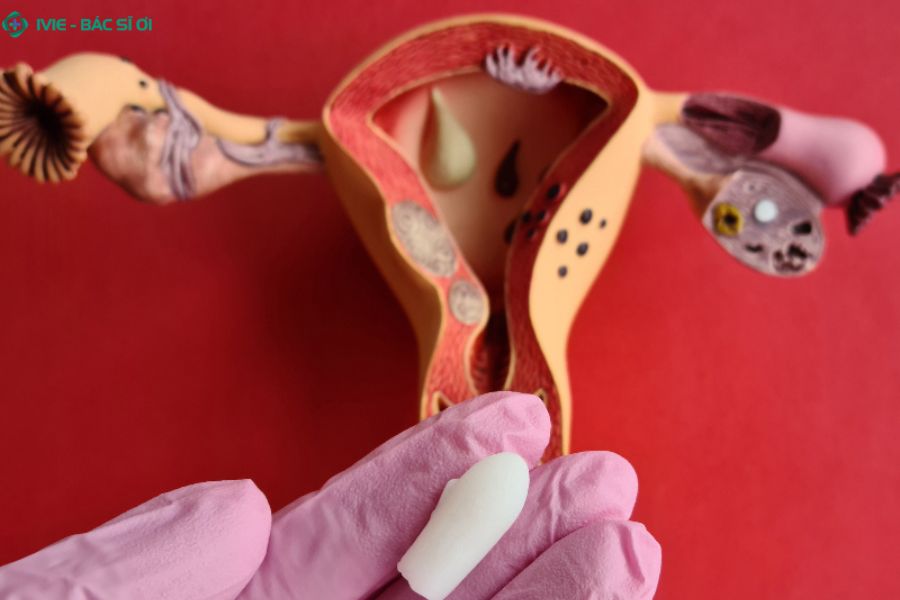 Đặt thuốc phụ khoa đúng cách đưa viên thuốc vào sâu trong âm đạo giúp thuốc tan nhanh