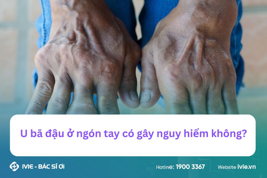 U bã đậu ở ngón tay có gây nguy hiểm không?