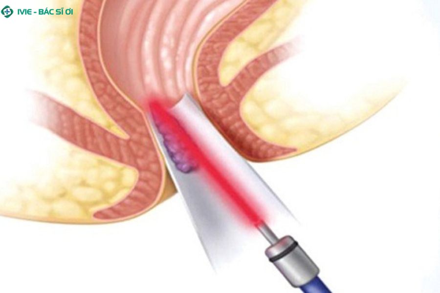 Hướng điều trị phù hợp cho trĩ độ 3