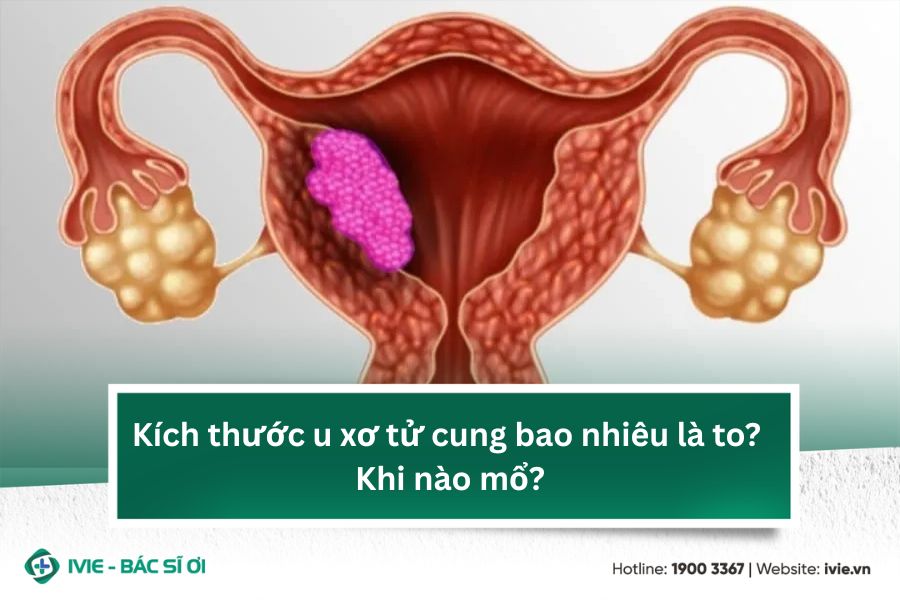 Kích thước u xơ tử cung bao nhiêu là to? Khi nào mổ?
