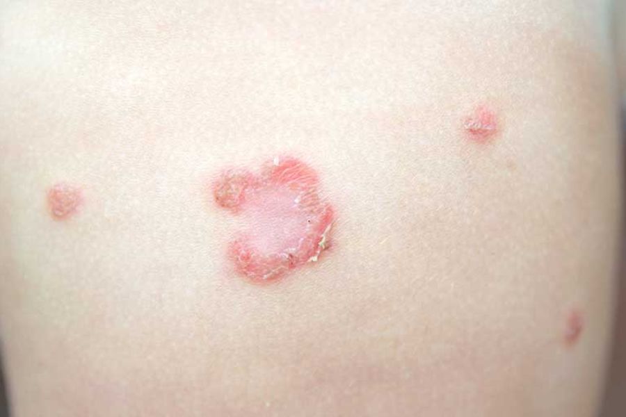 Viêm da mủ là tình trạng nhiễm khuẩn ngoài da, gây sưng đỏ, nổi mụn mủ và đau rát tại vùng tổn thương