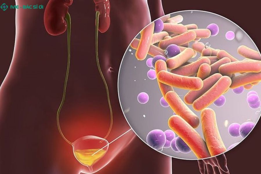 Vi khuẩn E.coli xâm nhập từ hậu môn lên niệu đạo, gây tiểu buốt, tiểu rát và tiểu nhiều lần