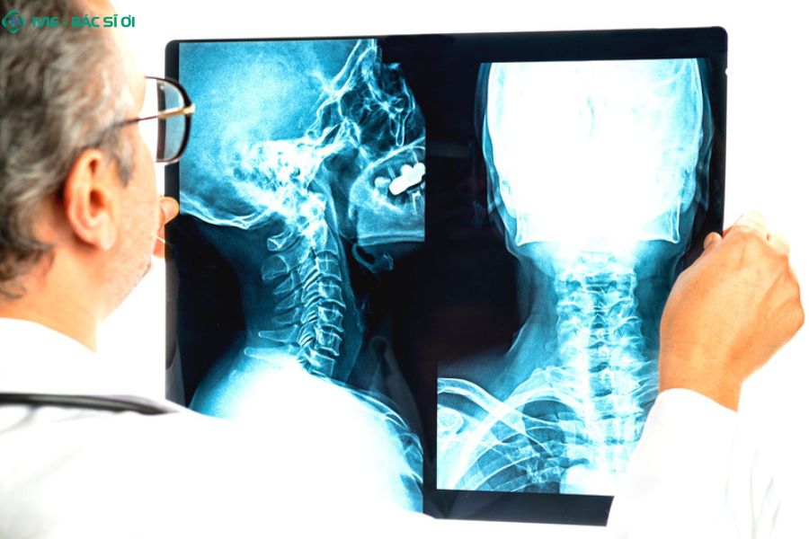 Phương pháp chẩn đoán đau cổ vai gáy bên trái