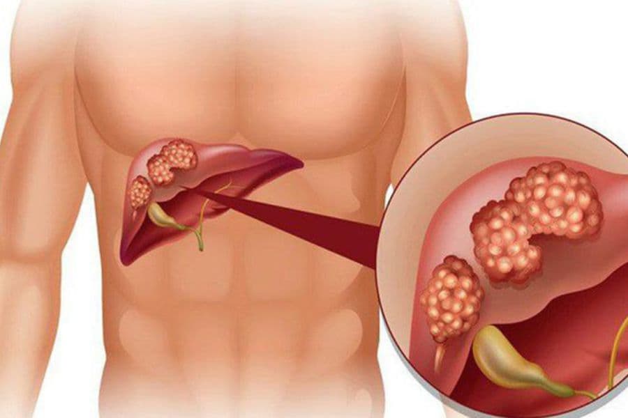 U gan đa ổ có phải là ung thư gan không?