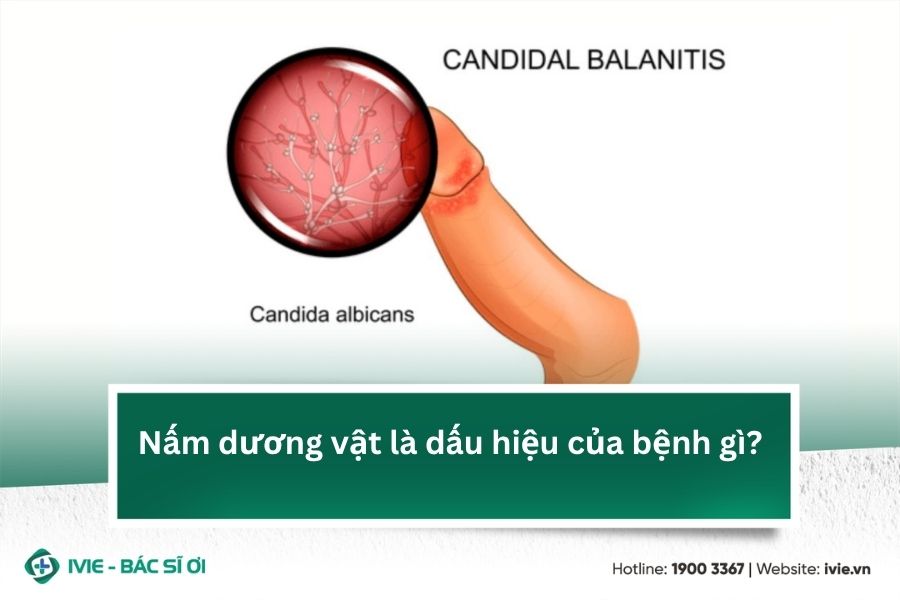 Nấm dương vật là dấu hiệu của bệnh gì?