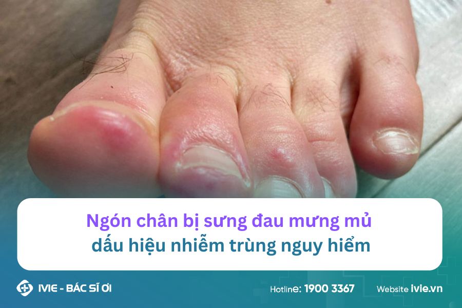 Ngón chân bị sưng đau mưng mủ dấu hiệu nhiễm trùng nguy hiểm