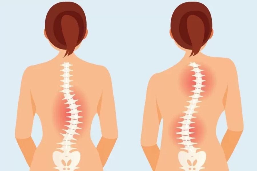 Cột sống bị lệch khỏi đường thẳng đứng tự nhiên khi nhìn từ phía sau