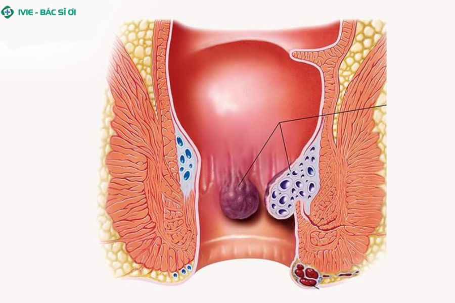 Biến chứng của trĩ độ 3 nếu không điều trị sớm