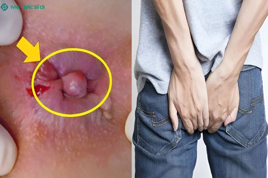 Các dấu hiệu cho thấy bạn có thể bị trĩ độ 3