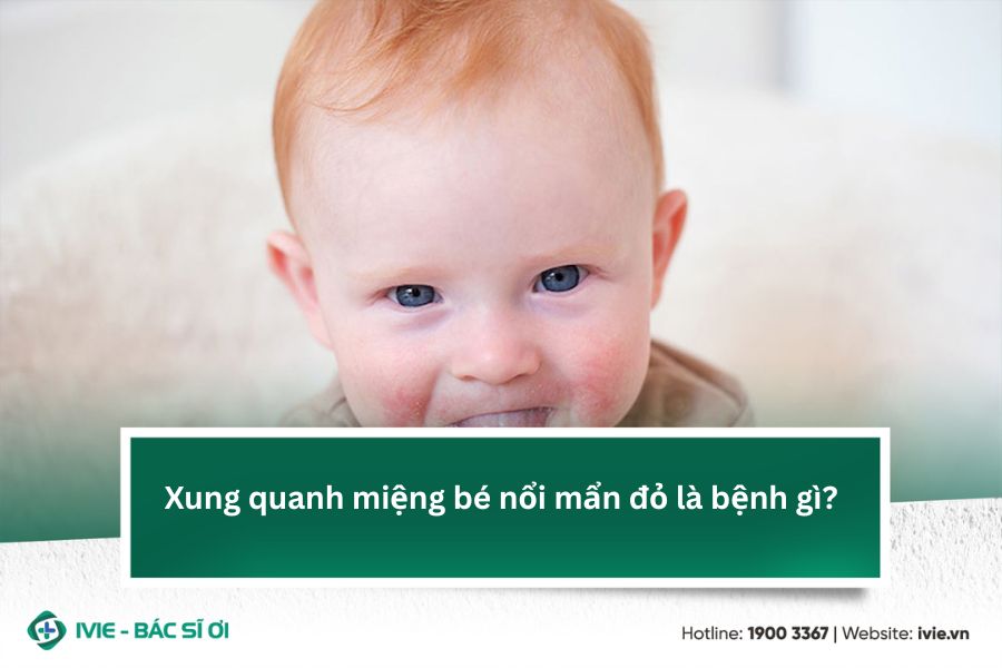 Xung quanh miệng bé nổi mẩn đỏ là bệnh gì?