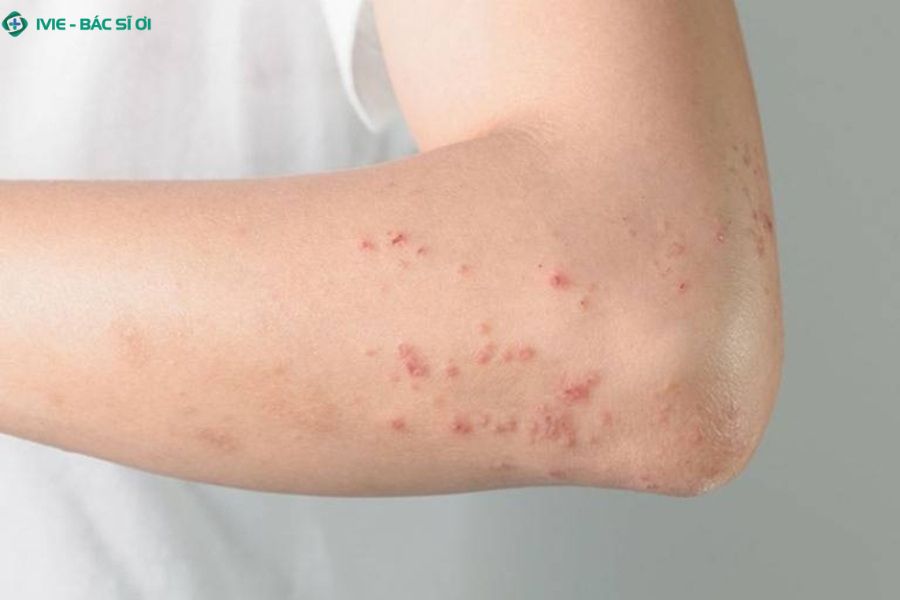 Các nốt có thể xuất hiện đơn lẻ hoặc thành từng cụm, màu sắc đỏ nhạt hoặc đỏ sẫm, đôi khi hơi gồ cao so với bề mặt da