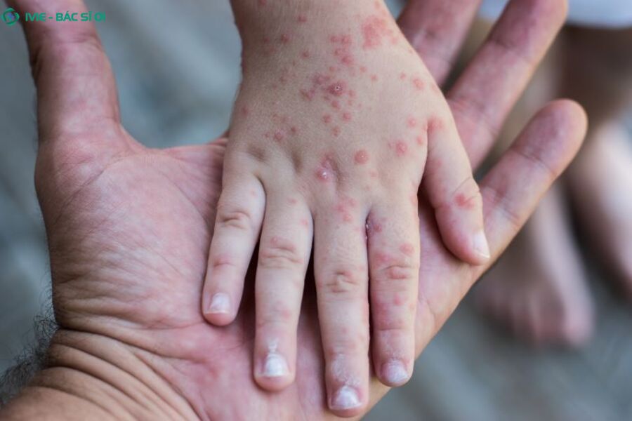 Nguyên nhân và triệu chứng của bệnh rubella