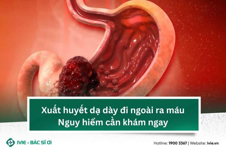 Xuất huyết dạ dày đi ngoài ra máu: Nguy hiểm cần khám ngay