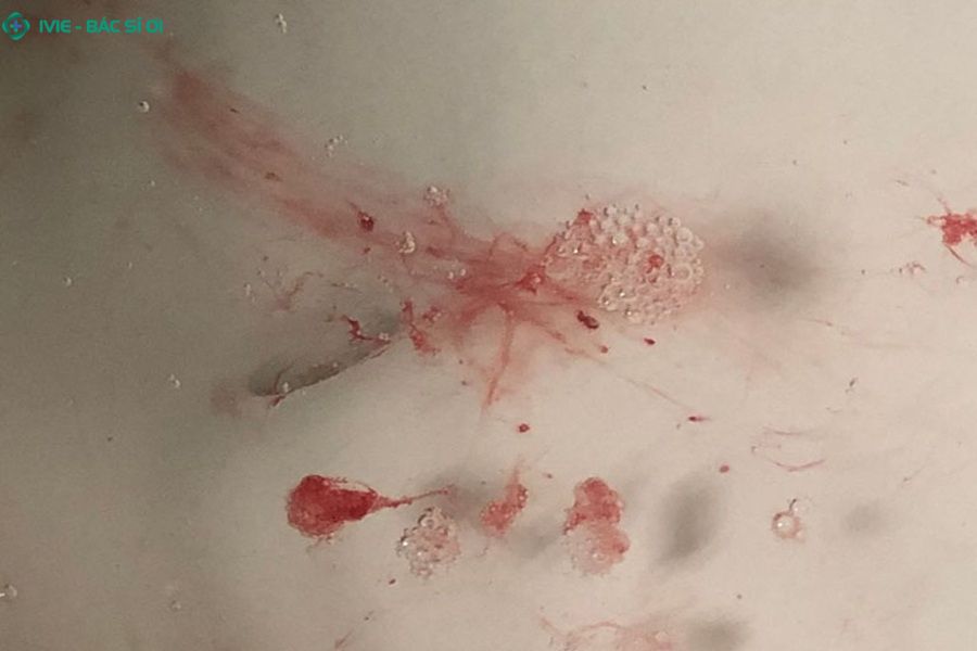 Xuất huyết dạ dày vô cùng nguy hiểm ở người già