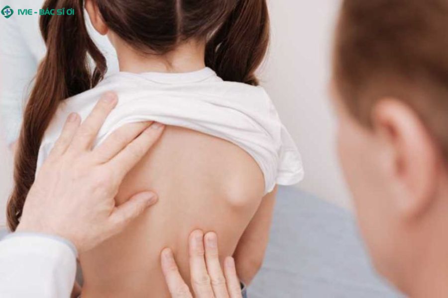 Cần đưa trẻ đi khám khi có dấu hiệu lệch vai, dáng đi bất thường hoặc đau lưng kéo dài - đặc biệt nếu có yếu tố di truyền