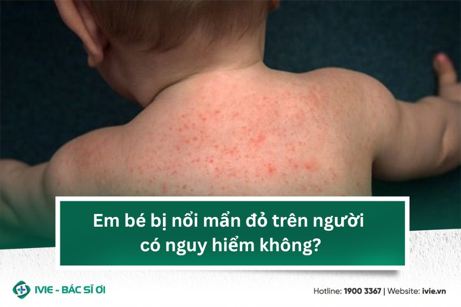 Em bé bị nổi mẩn đỏ trên người có nguy hiểm không?