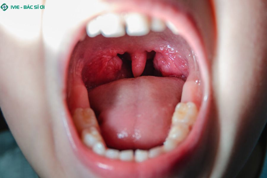 Viêm amidan ở trẻ có tự khỏi không? Tìm hiểu cách chăm sóc và điều trị kịp thời