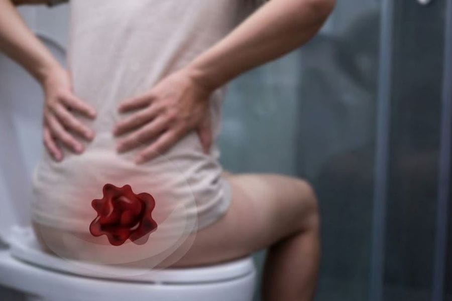Đi ngoài ra máu có thể xuất phát từ bệnh trĩ, nứt kẽ hậu môn hoặc các tổn thương đại tràng nghiêm trọng