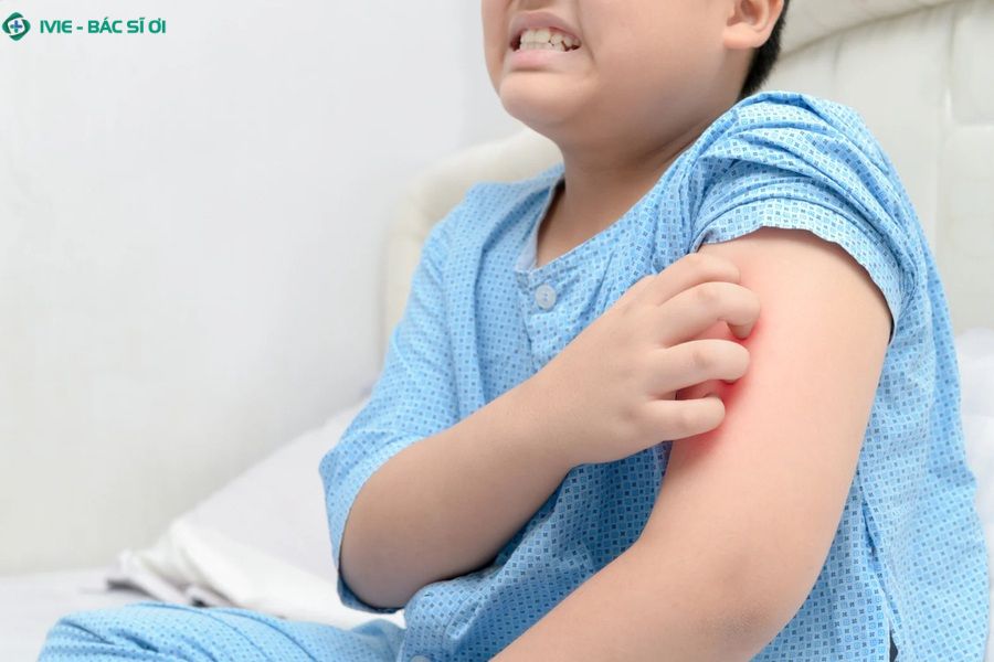 Tình trạng trẻ nổi mẩn đỏ sau khi tiêm phòng là tình trạng phổ biến