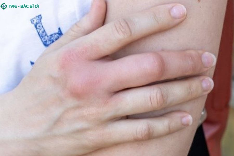 Ngón tay sưng, đỏ, đau nhức dấu hiệu cảnh báo bệnh khớp không nên bỏ qua
