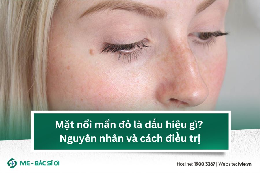 Mặt nổi mẩn đỏ là dấu hiệu gì? Nguyên nhân và cách điều trị