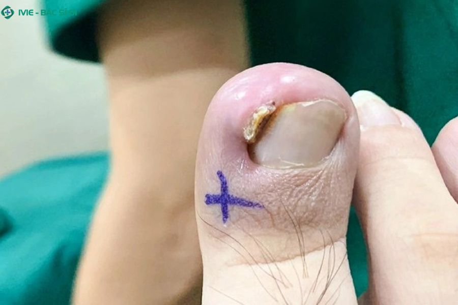 Sưng to, có mùi hôi, sốt, mủ không thoát ra là dấu hiệu cảnh báo nhiễm trùng nặng cần gặp bác sĩ ngay