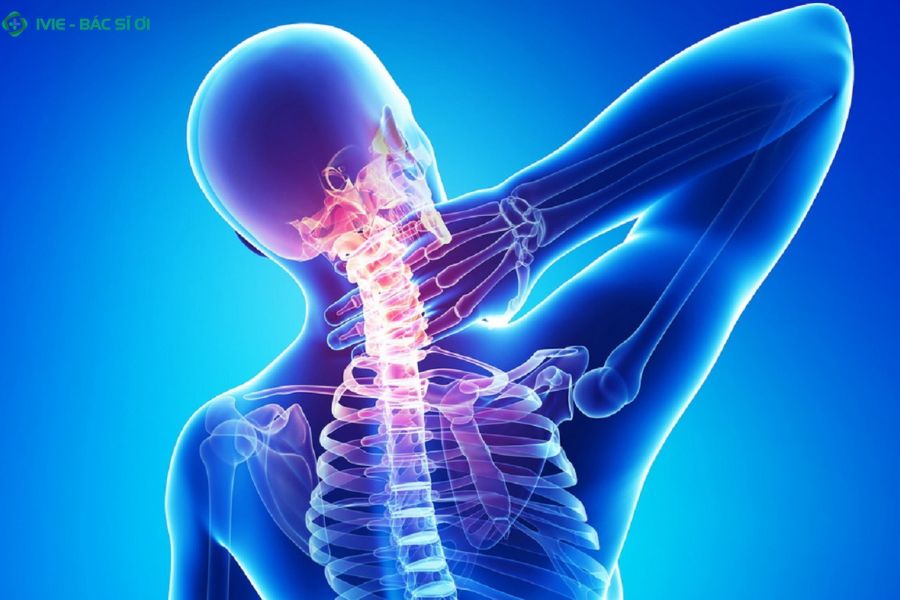 Thoát vị đĩa đệm cổ cảnh báo những cơn đau cổ vai, tê tay