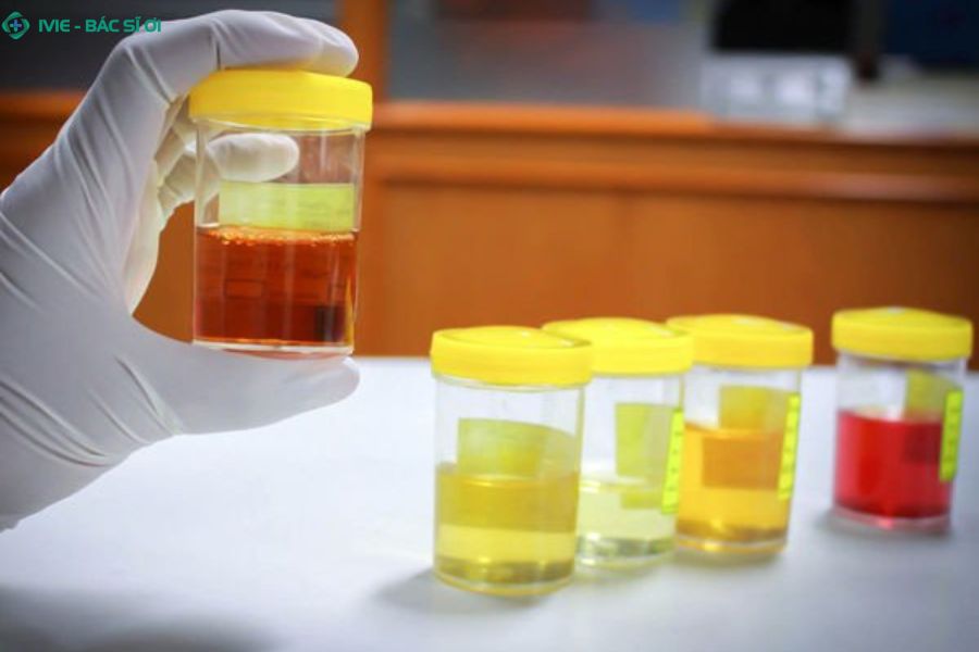 Tìm hiểu nguyên nhân khiến nước tiểu có màu vàng và cách nhận biết dấu hiệu bất thường