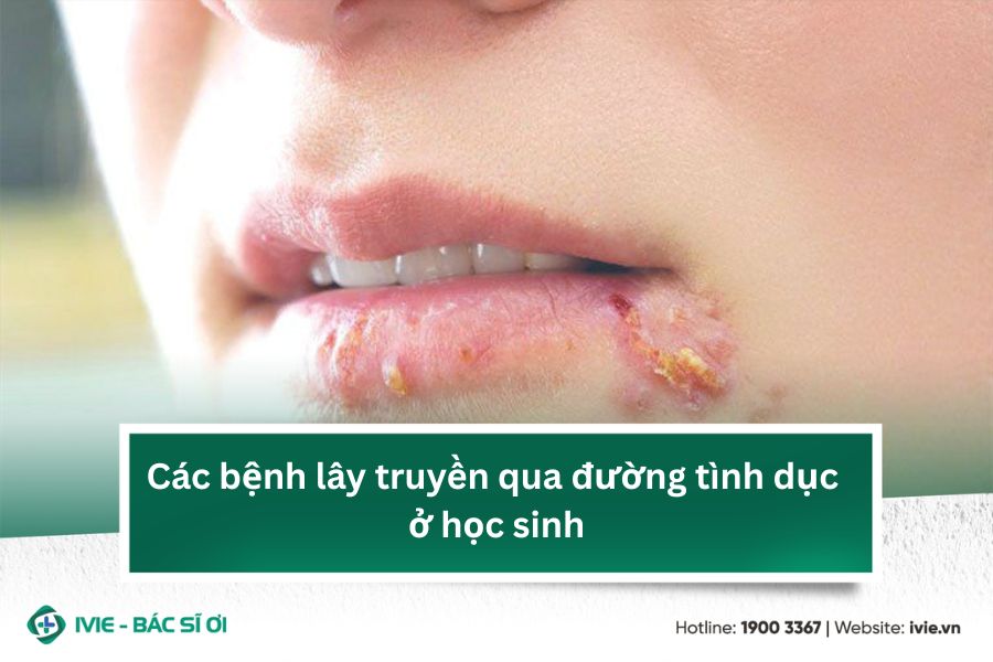 Các bệnh lây truyền qua đường tình dục ở học sinh