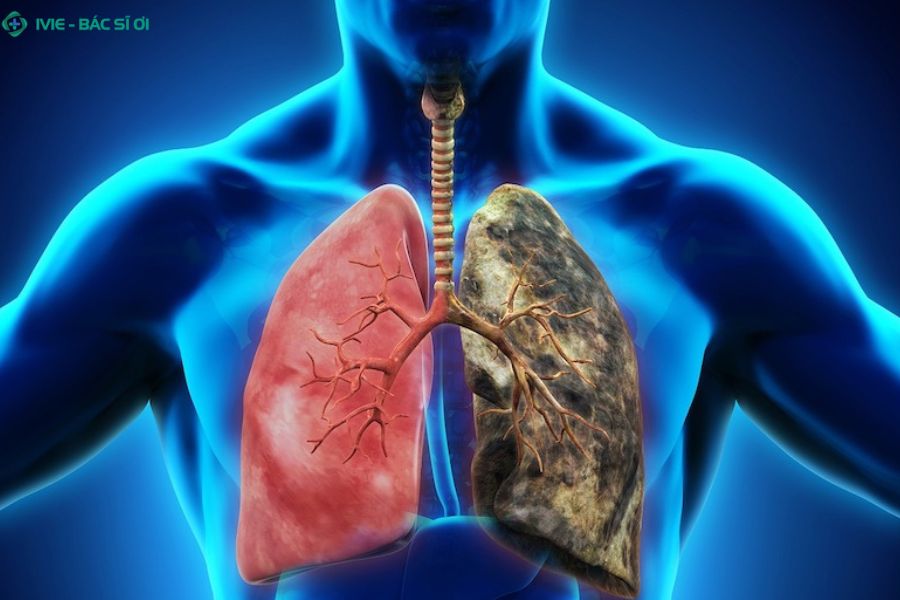 Dấu hiệu nhận biết ung thư phổi và tầm quan trọng của phát hiện sớm