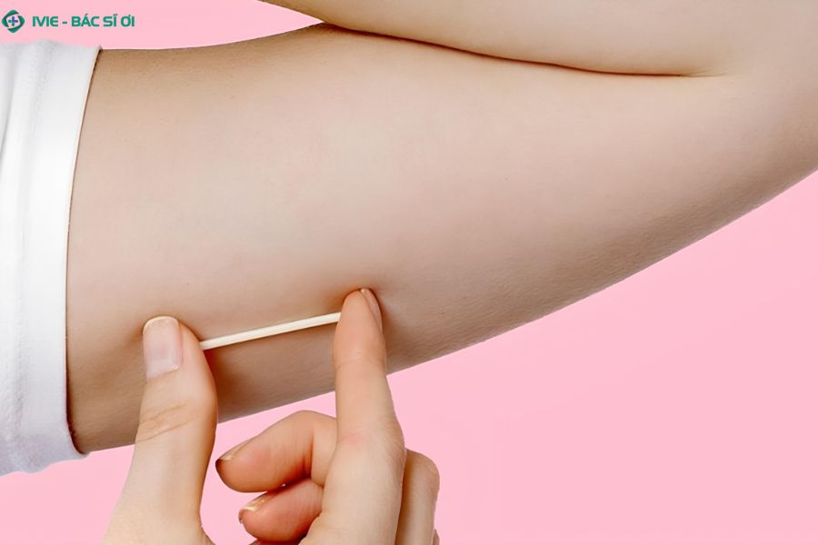 Que cấy tránh thai hiệu quả 99%, bảo vệ tới 3 năm