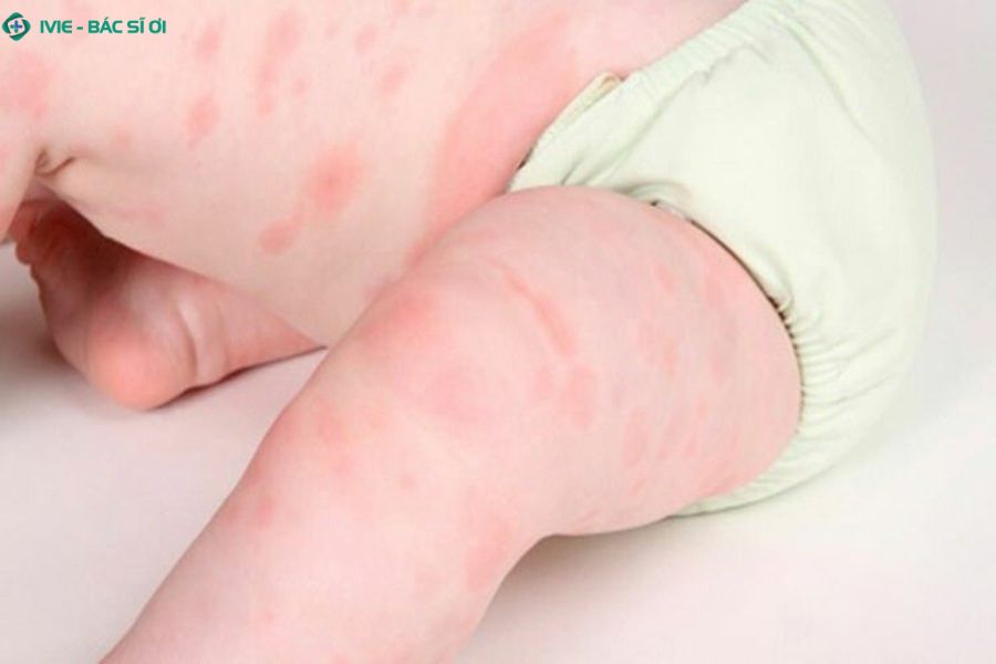 Thời tiết thay đổi đột ngột có thể khiến em bé nổi mẩn đỏ