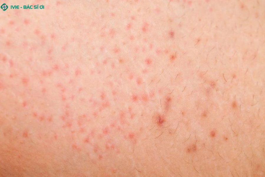 Nguyên nhân dẫn tới nổi mẩn đỏ ở mông nhưng không ngứa