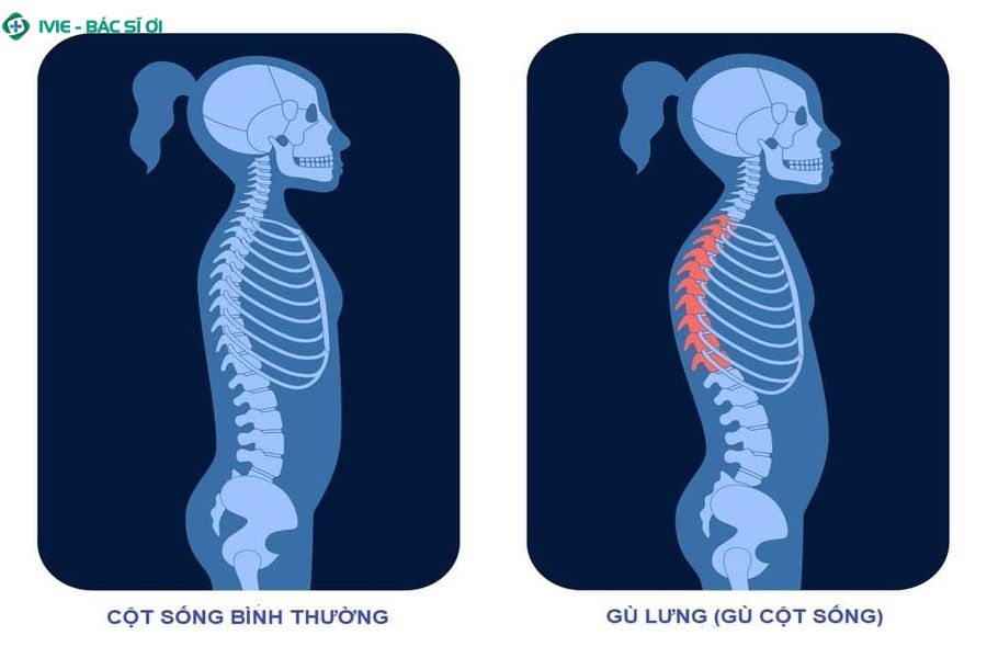 Dấu hiệu nhận biết gù lưng ở trẻ em