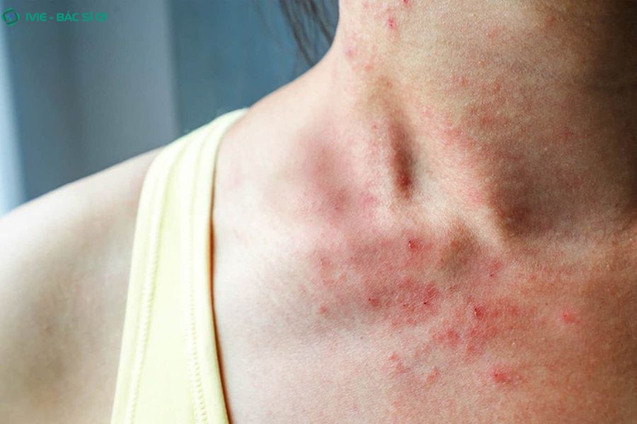 Nguyên nhân dẫn tới viêm da tiếp xúc dị ứng