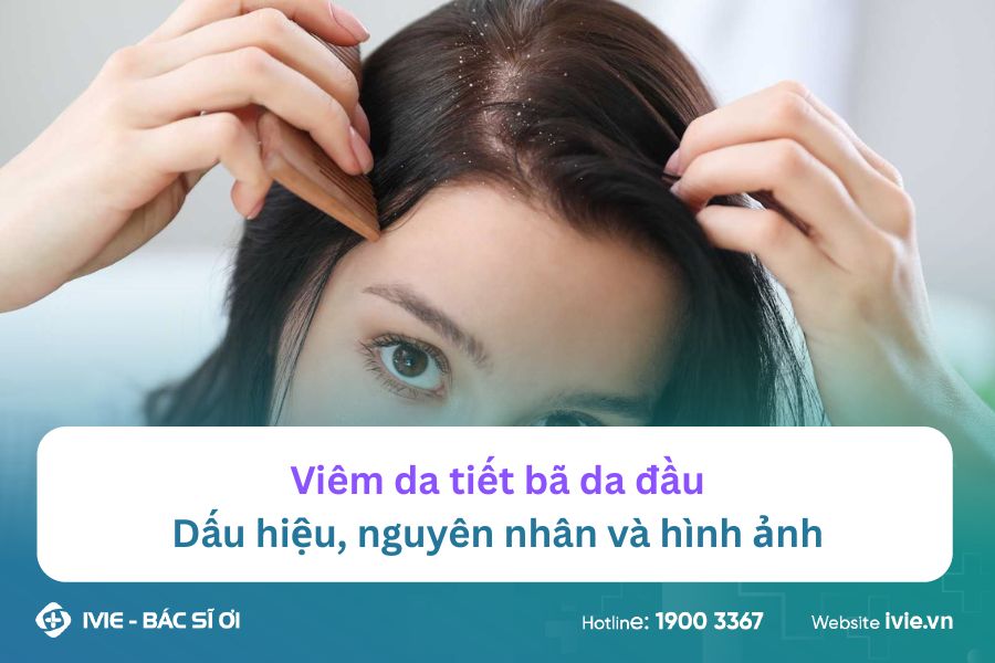 Viêm da tiết bã da đầu: Dấu hiệu, nguyên nhân và hình ảnh
