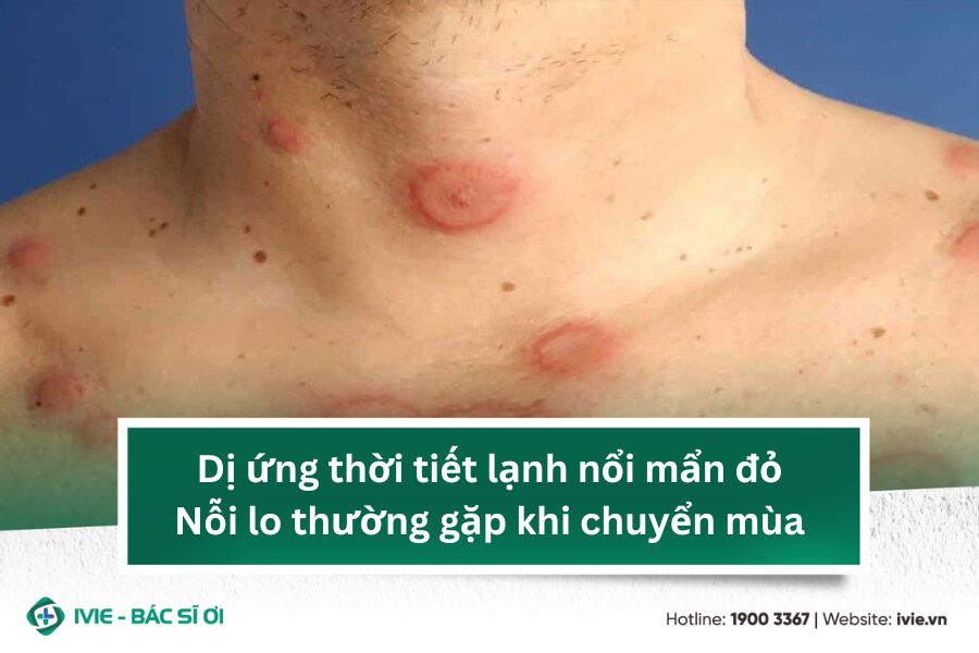 Dị ứng thời tiết lạnh nổi mẩn đỏ - Nỗi lo thường gặp khi...