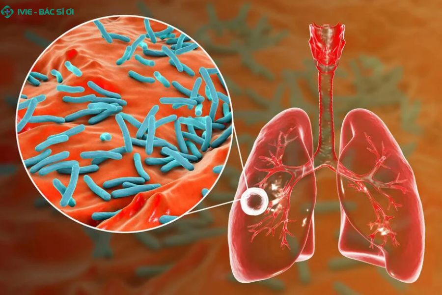 Triệu chứng thường gặp và cách chẩn đoán bệnh lao phổi
