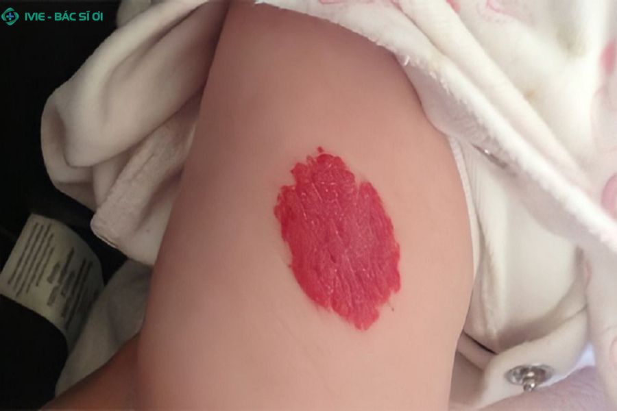 U máu thường biểu hiện bằng các nốt đỏ hoặc mảng đỏ nổi rõ trên bề mặt da