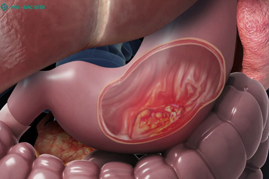 Quyết định mổ sẽ dựa trên đánh giá tổng thể của bác sĩ, bao gồm mức độ chảy máu, nguyên nhân, thể trạng người bệnh và khả năng đáp ứng điều trị