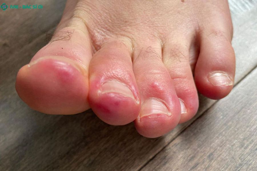 Triệu chứng đi kèm thường gặp khi ngón cái bị sưng đau