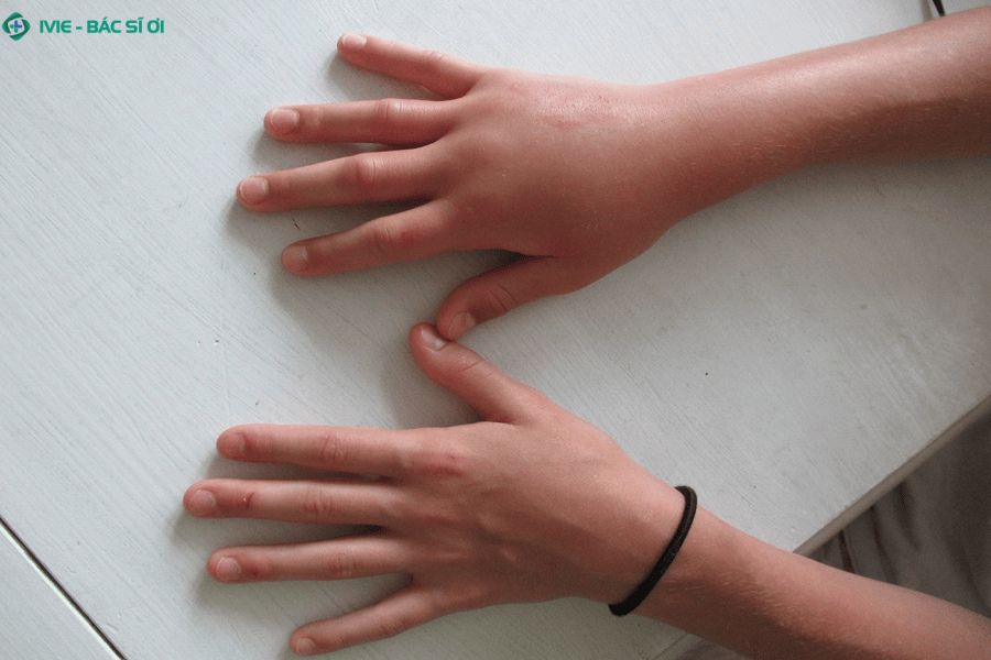 Phù nề ở tay và các ngón tay ở mẹ bầu
